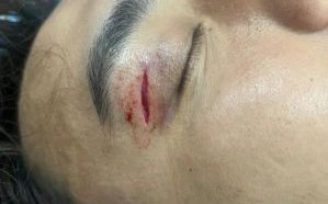 郭艾伦遭遇意外伤害，眼部受伤缝了40针：“我不知道会不会瞎
