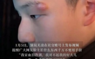 女演员深夜向儿子道歉：我一失手，他缝了四针……很多人都有这个习惯！