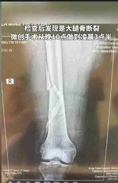 向太陈岚不幸摔倒入院抢救！身体骨折情况严重，大腿打了四根髓钉（向太陈岚多少斤）-第6张图片-九妖电影