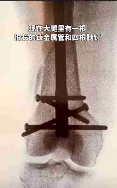 向太陈岚不幸摔倒入院抢救！身体骨折情况严重，大腿打了四根髓钉（向太陈岚多少斤）-第7张图片-九妖电影